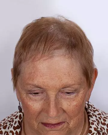   solutions before after womens gallery hair restoration systems 03 womens hair restoration systems before and after photo 02
