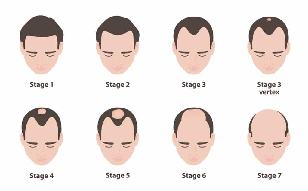 When Do Men Usually Start Balding?