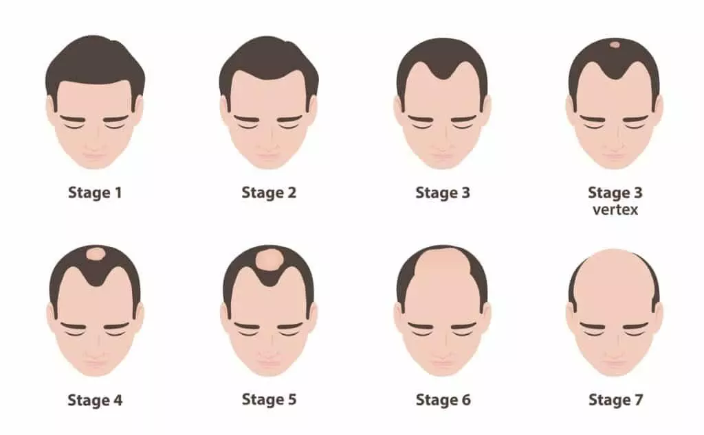 When Do Men Usually Start Balding? When Do Men Usually Start Balding?