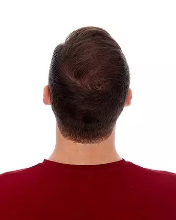   solutions before after mens gallery cyberhair micro point 01 mens cyberhair micro point before and after photo 01
