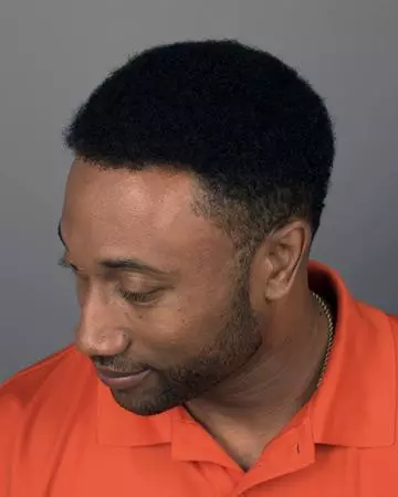 19 mens hair restoration systems before and after photo 01 solutions before after mens gallery hair restoration systems 19 mens hair restoration systems before and after photo 01