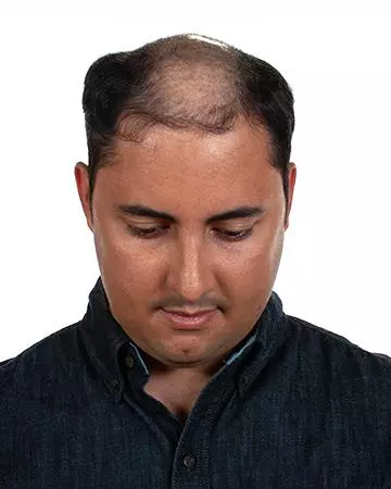   solutions before after mens gallery hair restoration systems 21 mens hair restoration systems before and after photo 02